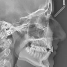 Japan is testing an experimental drug that could help people grow new teeth by…