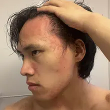 每天晚上睡不到两个小时就要被痒醒 靠一口气吊着