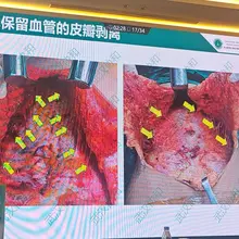 学无止境，跨性别及相关手术，整形外科年会含金量很高