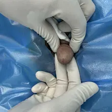 脱细胞真皮+玻尿酸注射，阴茎直接增粗2cm，短期玻尿酸长期真皮。持续增粗。