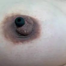今天去取出了滞留在乳房里面的螺丝钉，进行了换药，换成了尺寸更大一些的硅胶尿道棒，扩张的道路还很漫长。感谢大家支持。
